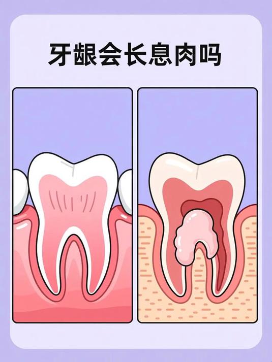 牙龈会长息肉吗 #健康扬帆季#