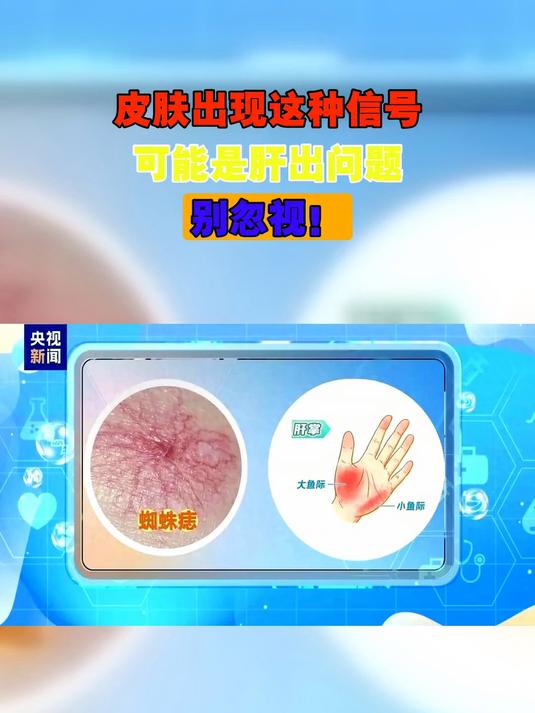 皮肤出现这种信号，可能是肝出问题，别忽视！
