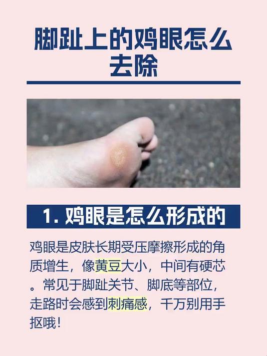 脚趾上的鸡眼怎么去除