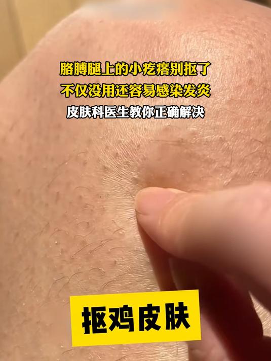 胳膊腿上的小疙瘩别抠了,不仅没用还容易感染发炎