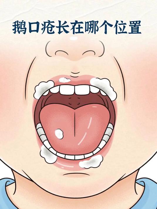 鹅口疮长在哪个位置 #健康扬帆季#