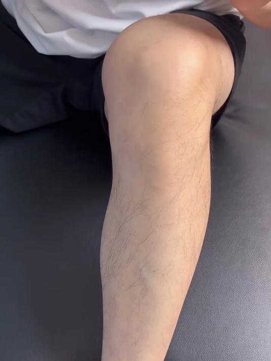 精准定位鹅足腱！膝关节内下鹅足腱疼痛，不适，就这样松解