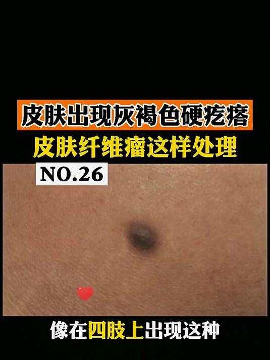 皮肤出现灰褐色的硬硬的小疙瘩，这可能是 皮肤纤维瘤
