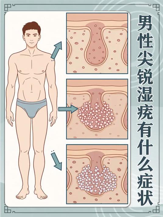 男性湿锐疣有什么症状 #健康扬帆季#