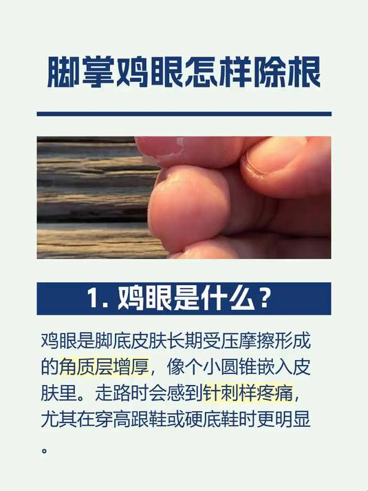 脚掌鸡眼怎样除根