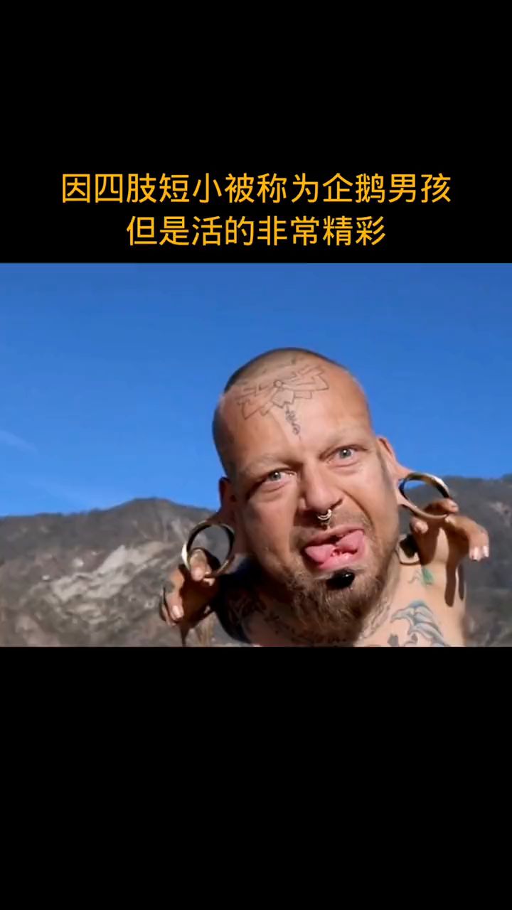 因四肢短小被称为企鹅男孩