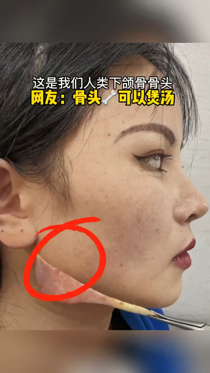 这是我们人类下颌骨骨头,今天终于不用担心大脸的问题了