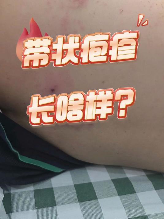 带状疱疹长啥样?