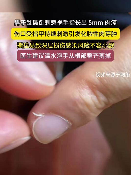 小习惯酿大祸！男子乱撕倒刺，手指长出 5mm 肉瘤需手术