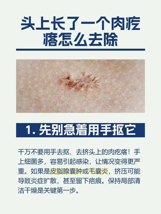 头上长了一个肉疙瘩怎么去除