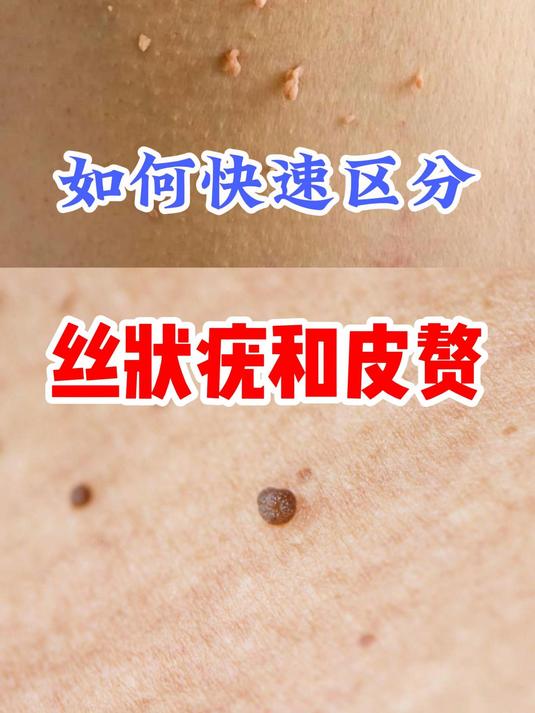 如何快速区分丝状疣和皮赘