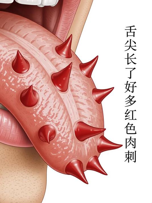 舌尖长了好多红色肉刺