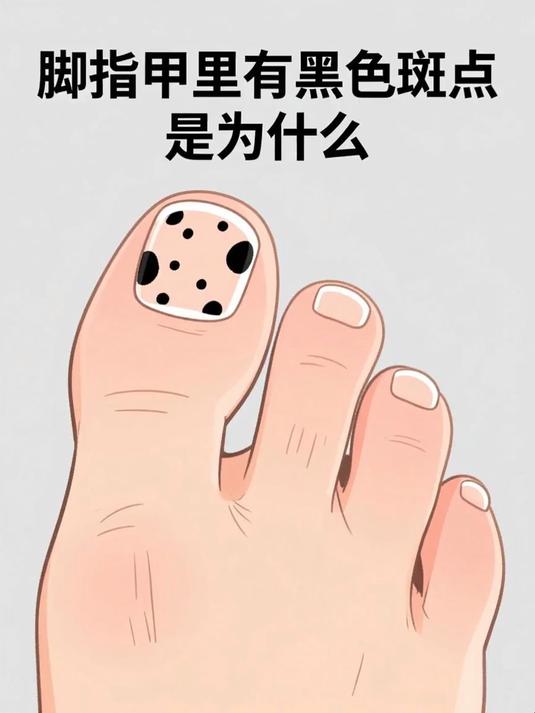 脚指甲里有黑色斑点是为什么 #健康扬帆季#