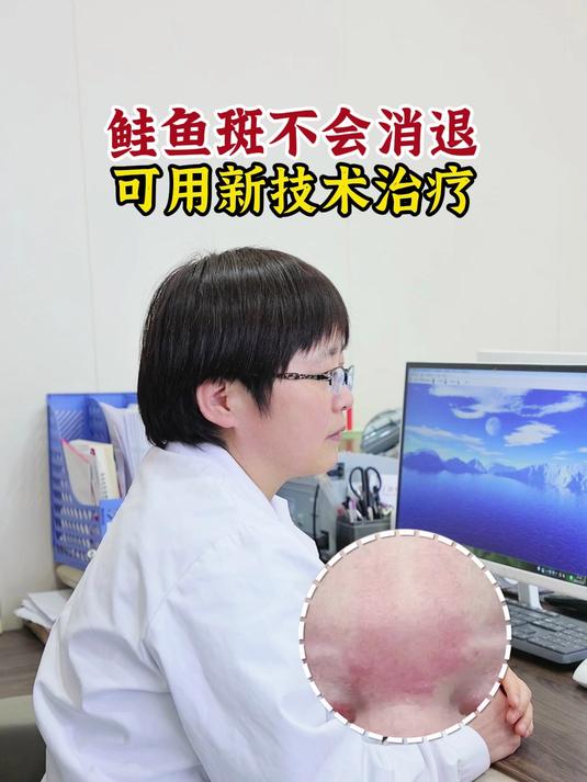 鲑鱼斑不会消退,可用新技术治疗