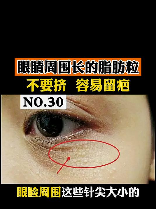 眼睛周围长的小肉粒，可能是 粟粒疹，千万别挤容易留疤