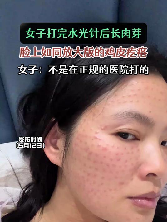 女子打完水光针后长肉芽,脸上如同放大版的鸡皮疙瘩#健康追热季#