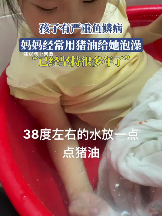 孩子有严重鱼鳞病，妈妈经常用猪油给她泡澡，“已经坚持很多年”