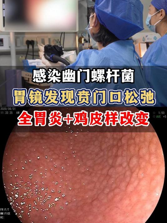 感染幽门螺杆菌,胃镜发现贲门口松弛,胃里鸡皮样改变