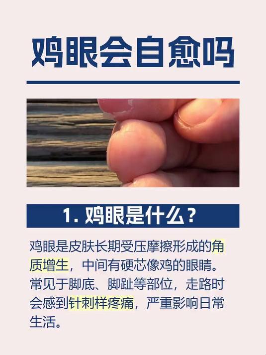 鸡眼会自愈吗