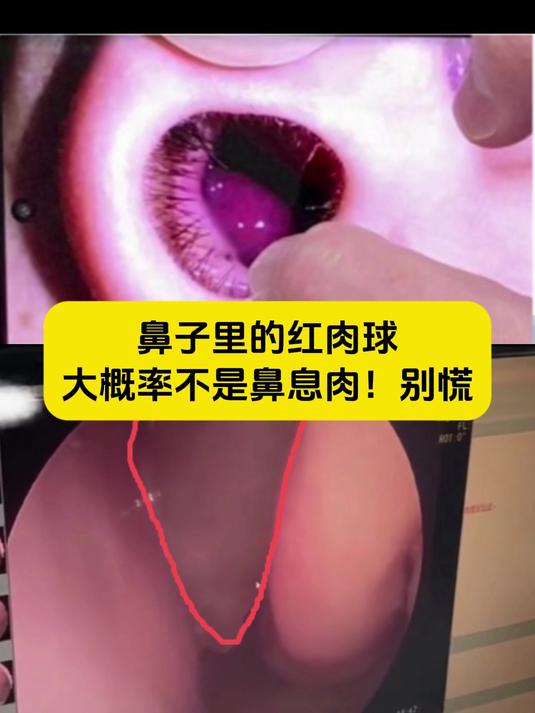 照镜子看到鼻子里的红肉球,大概率不是鼻息肉,别慌