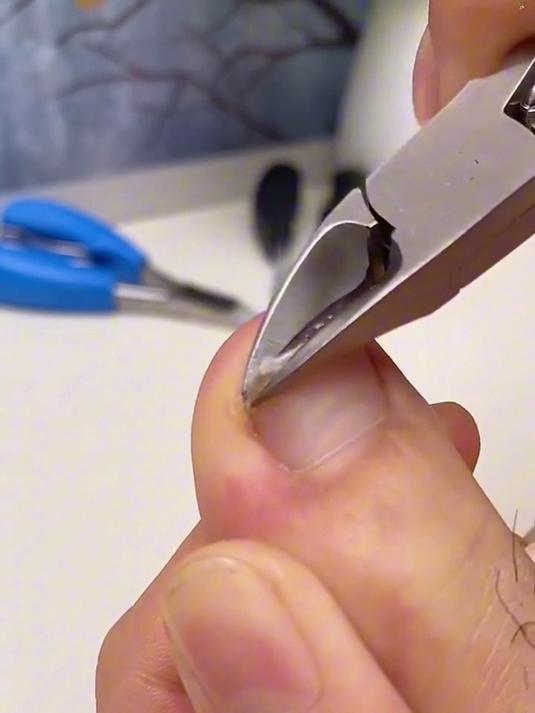 指甲往肉里长,走路特别疼,用这个鹰嘴钳,多厚多硬的指甲都能剪