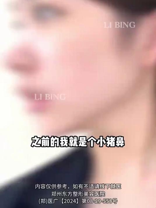 露鼻孔,没有鼻梁,鼻子短的小猪鼻手术3个月的真实照片!