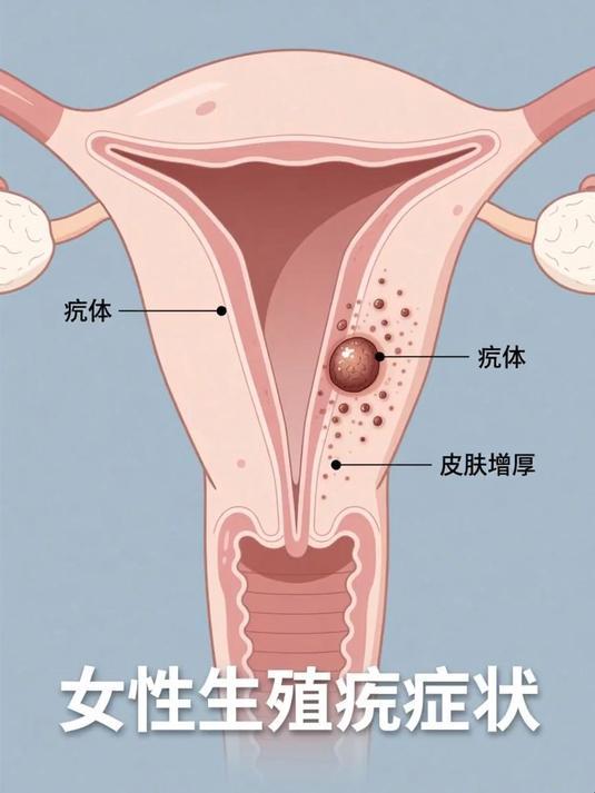 女性生殖疣症状 #健康扬帆季#