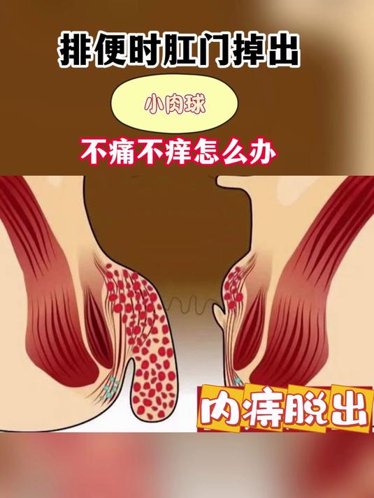排便时肛门掉出小肉球不痛不痒怎么办