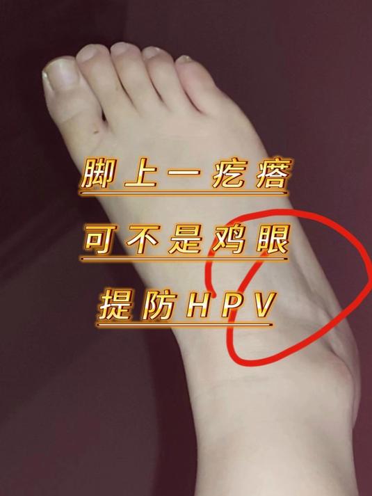 脚上一疙瘩，可不是鸡眼，提防HPV