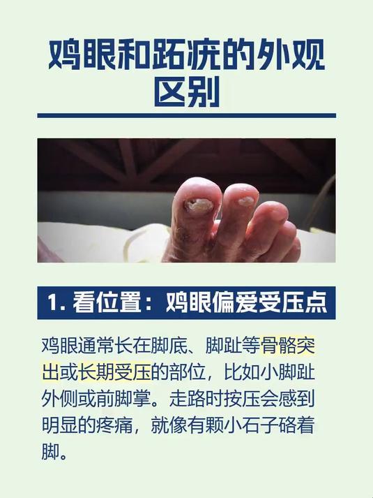 鸡眼和跖疣的外观区别