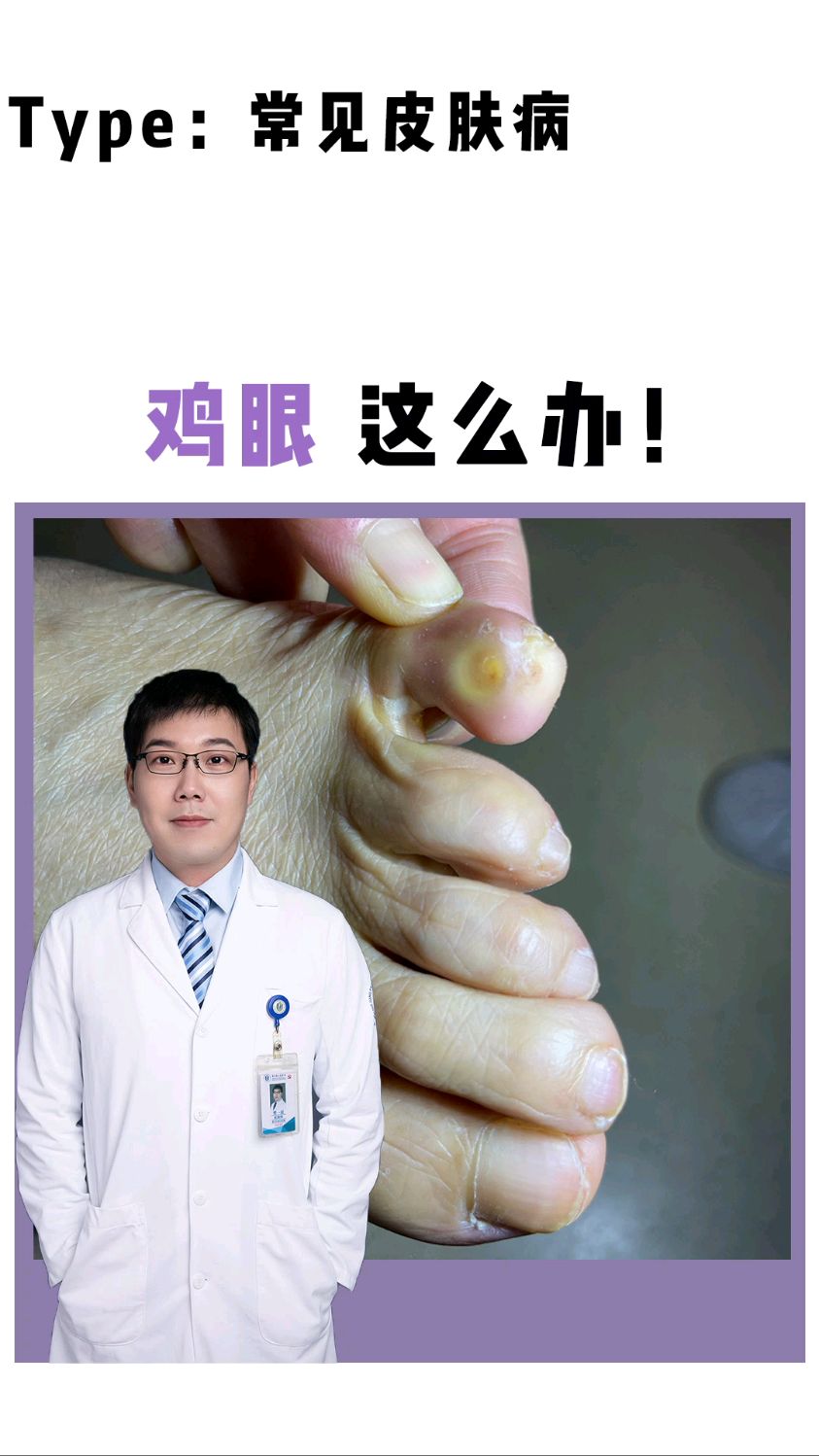 脸部呈黄色,按压有疼痛感,原来是鸡眼!