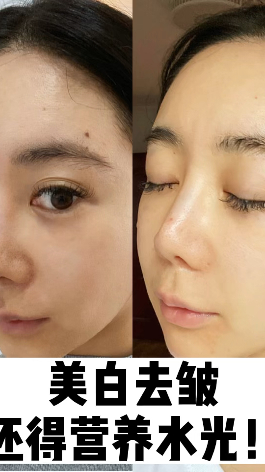 美白去皱?水光针可太适合了,没做过也听过的三文鱼水光!