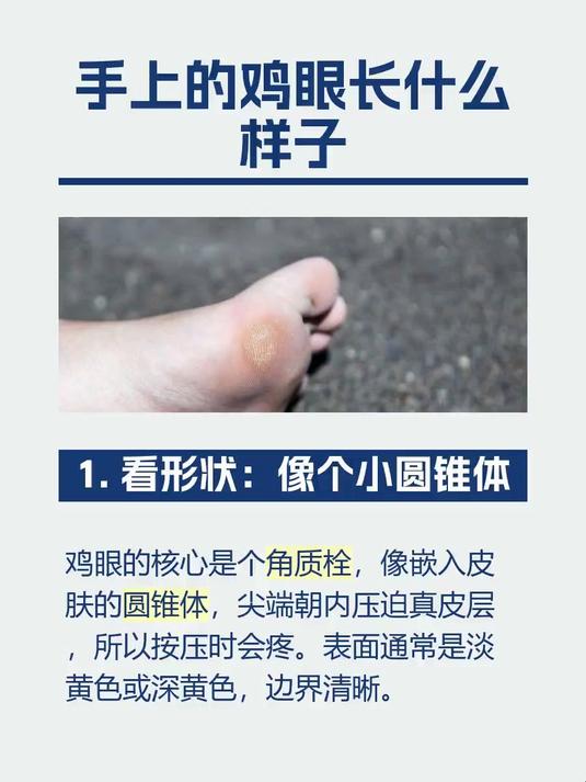 #马上健康过大年#手上的鸡眼长什么样子