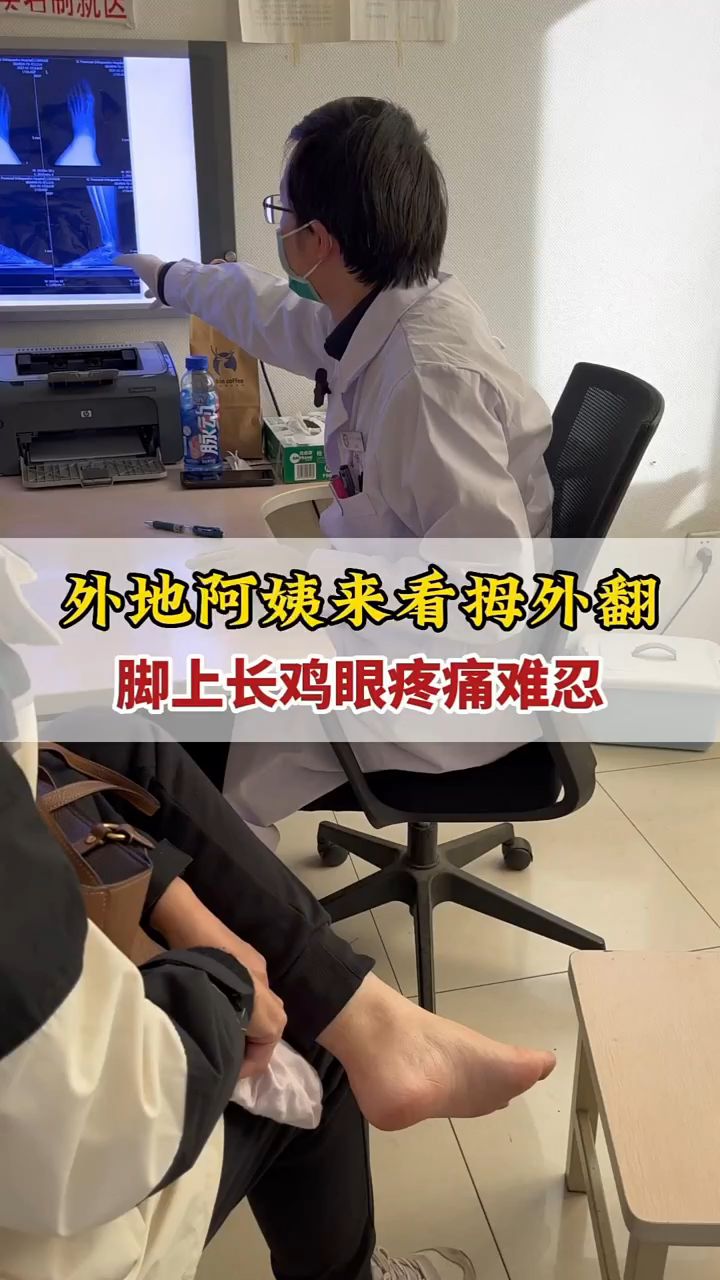 外地阿姨来看拇外翻,脚上长鸡眼疼痛难忍