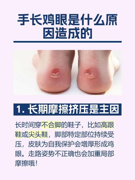 #马上健康过大年#手长鸡眼是什么原因造成的