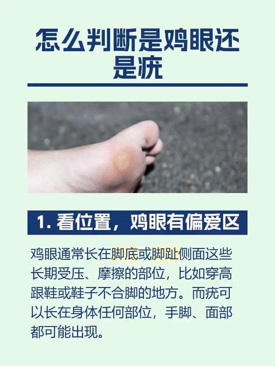 #马上健康过大年#怎么判断是鸡眼还是疣
