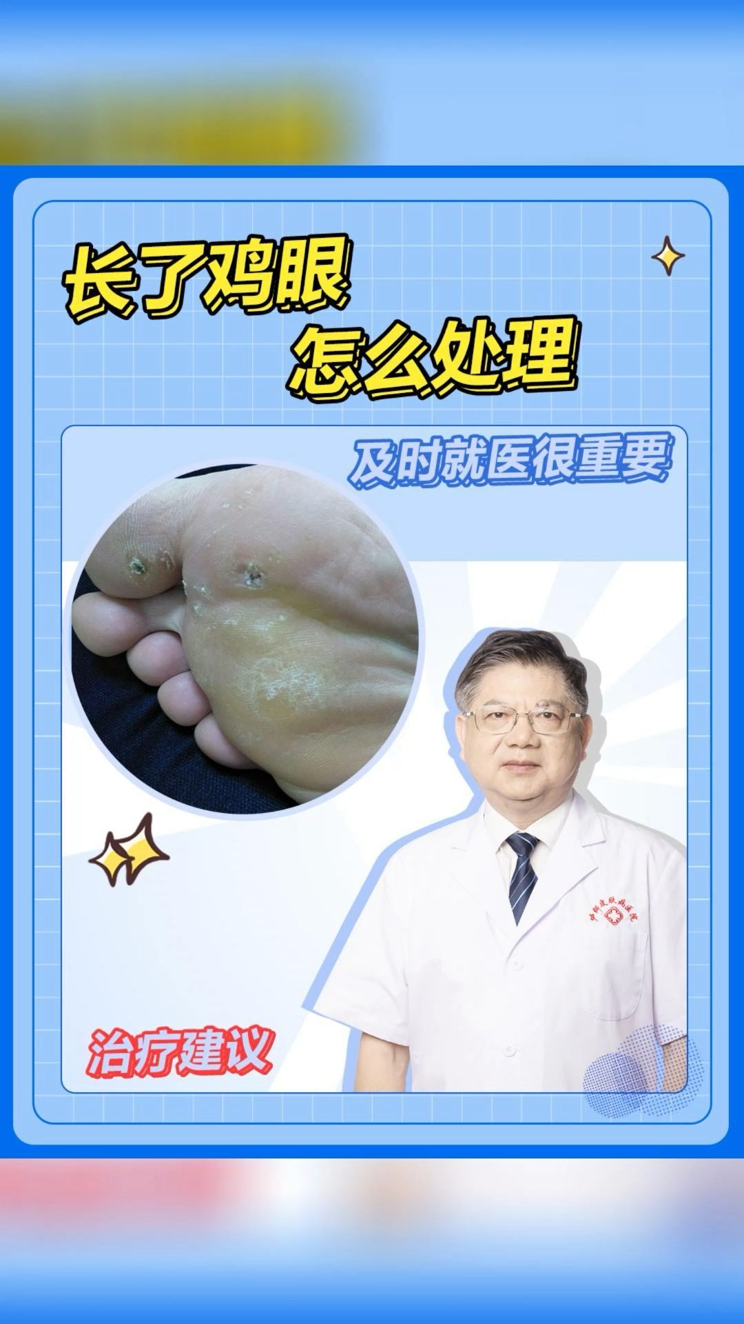 长了鸡眼怎么处理