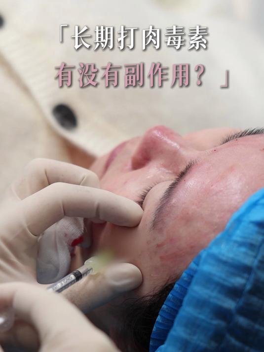 长期打肉毒素有没有副作用?
