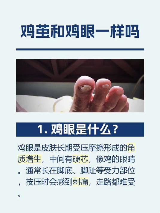 鸡茧和鸡眼一样吗