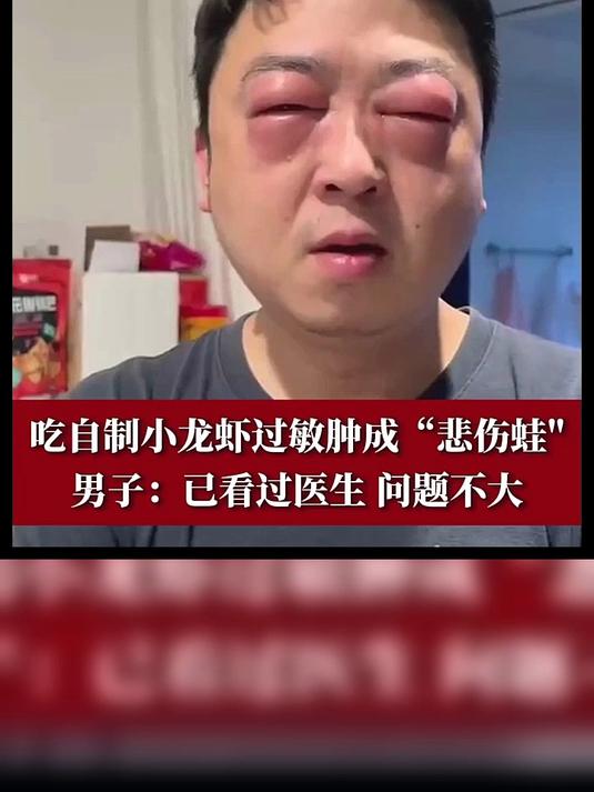 吃自制小龙虾过敏肿成悲伤蛙 男子:已看过医生 问题不大小龙虾