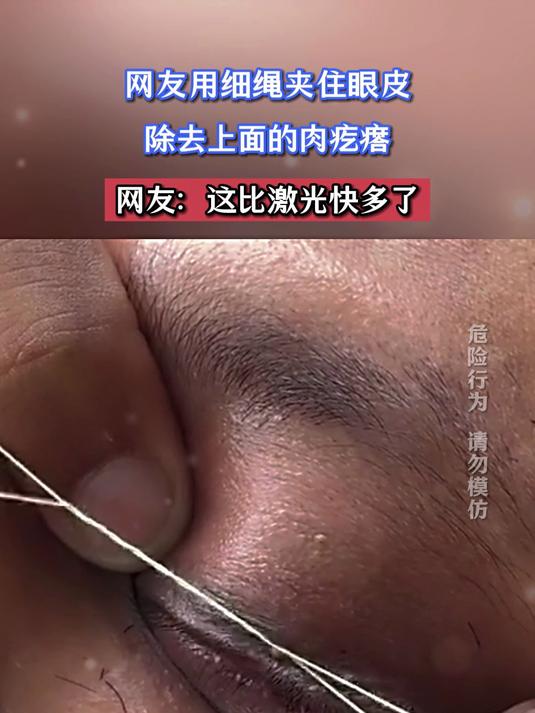 网友用细绳夹住眼皮，除去上面的肉疙瘩，网友：这比激光快多了