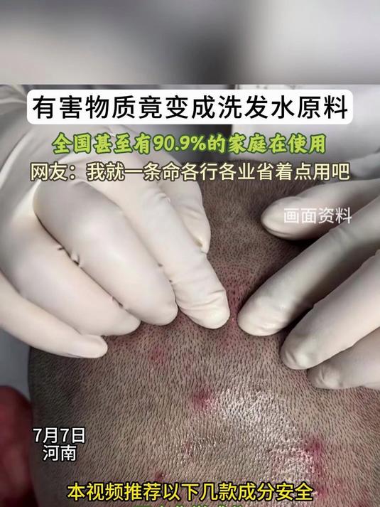 毛囊炎的根源就是有害物质洗发水,谨慎购买!