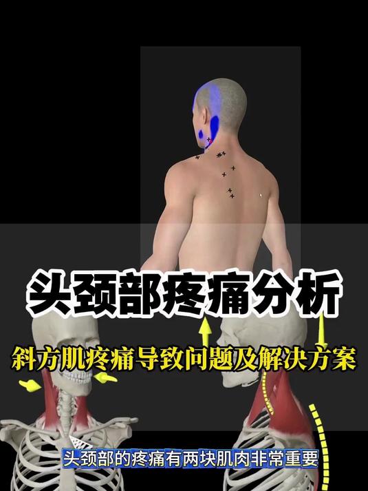 这个肌肉对头颈部疼痛非常重要！