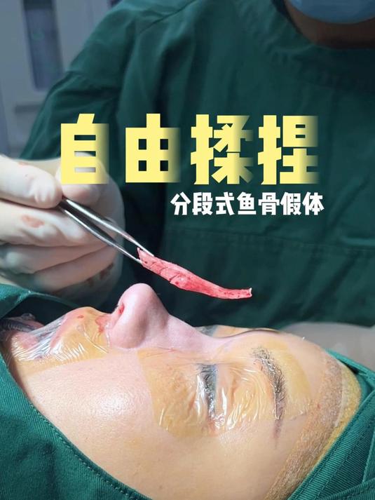 揭秘一下!自由揉捏鼻头,鼻背假体长什么样子#郑州李冰# #分段式鱼骨鼻# #变美逆袭# #