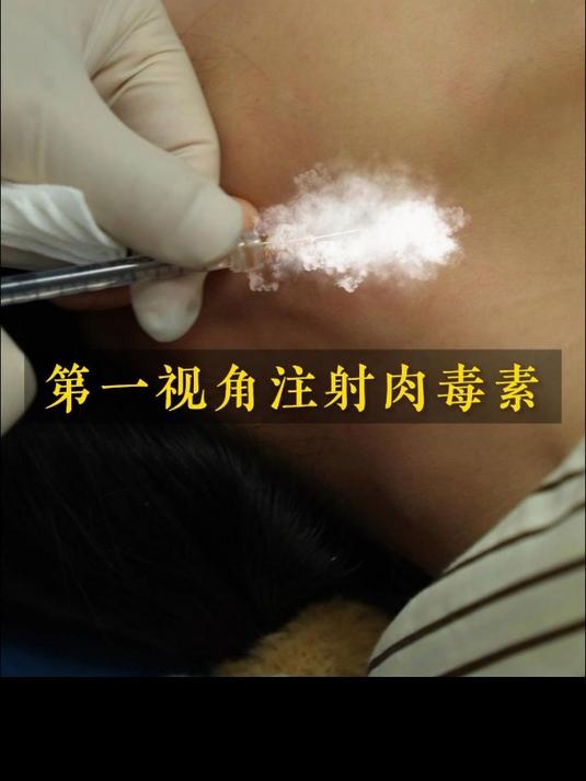 咬肌大怎么办 第一视角注射肉毒素