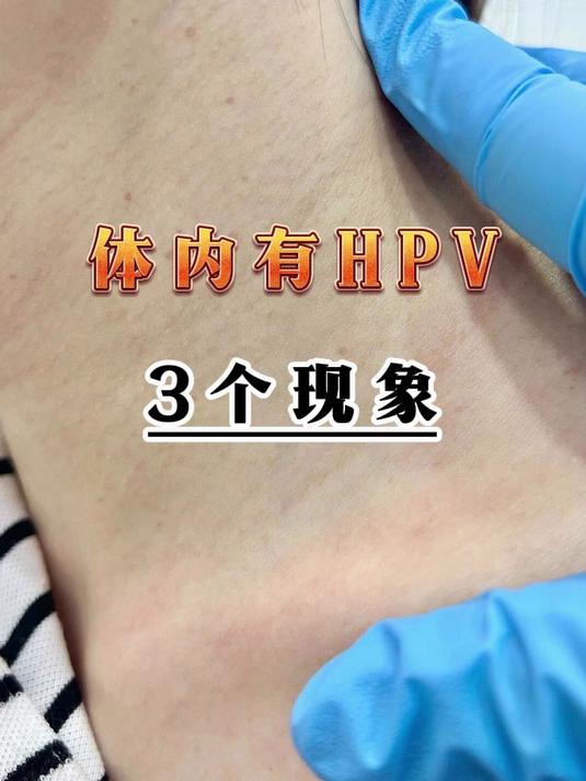 体内有hpv，3个现象很好识别