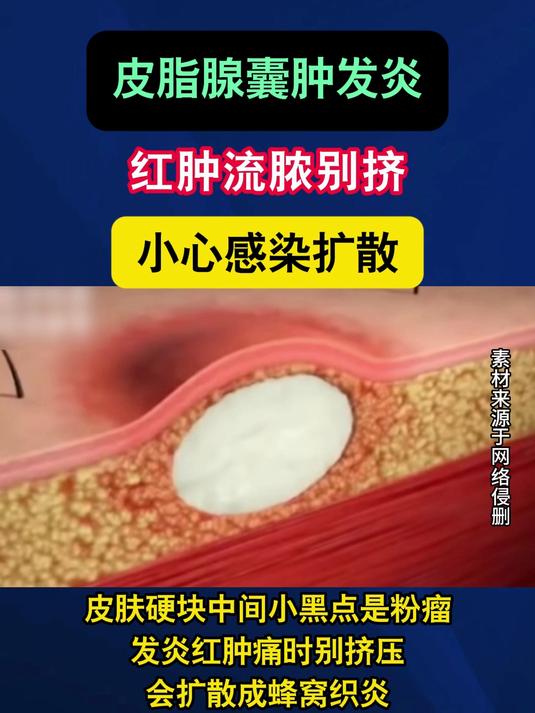 皮脂腺囊肿发炎？红肿流脓别挤！小心感染扩散#健康向阳计划#