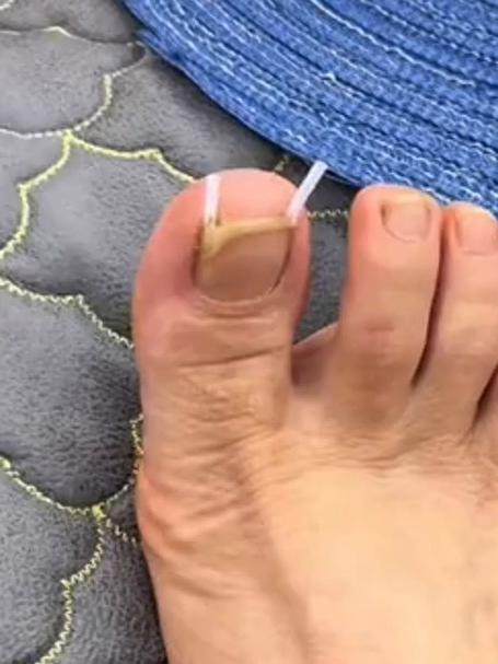 嵌甲分离片用起来，指甲不再往肉长，跟垫棉花般超舒坦！