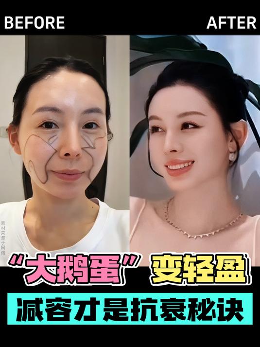 额头肿凸压眉压眼,馒化鹅蛋脸怎么办?减容提升才是抗衰秘诀