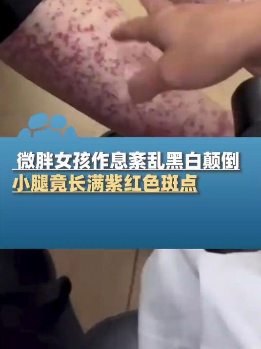 微胖女孩作息紊乱黑白颠倒,小腿竟长满紫红色斑点,中医:过敏性紫癜,可能会发展肾炎,过敏体质